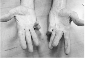 hand condition before kolagenaz treatment