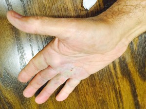 Dr. Rubinraut - hand condition after Kolagenaz injection