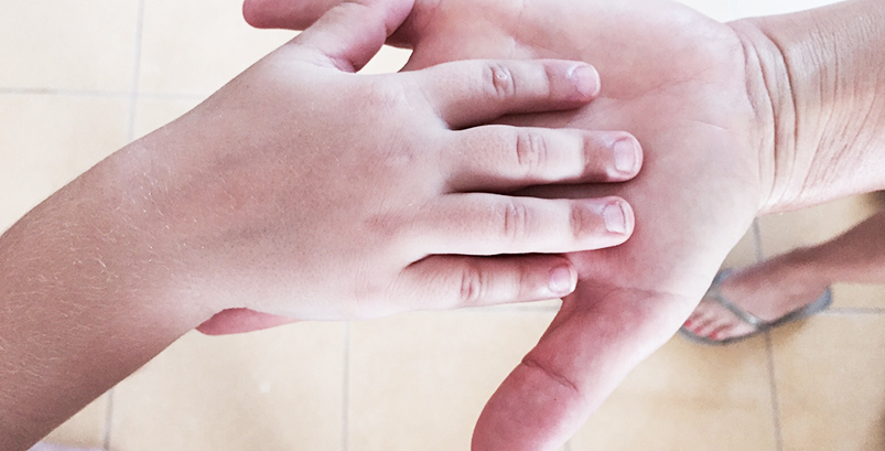 טיפול בפציעות ועיוותי כף יד בילדים - ד״ר אסתר רובינראוט מומחית כף יד